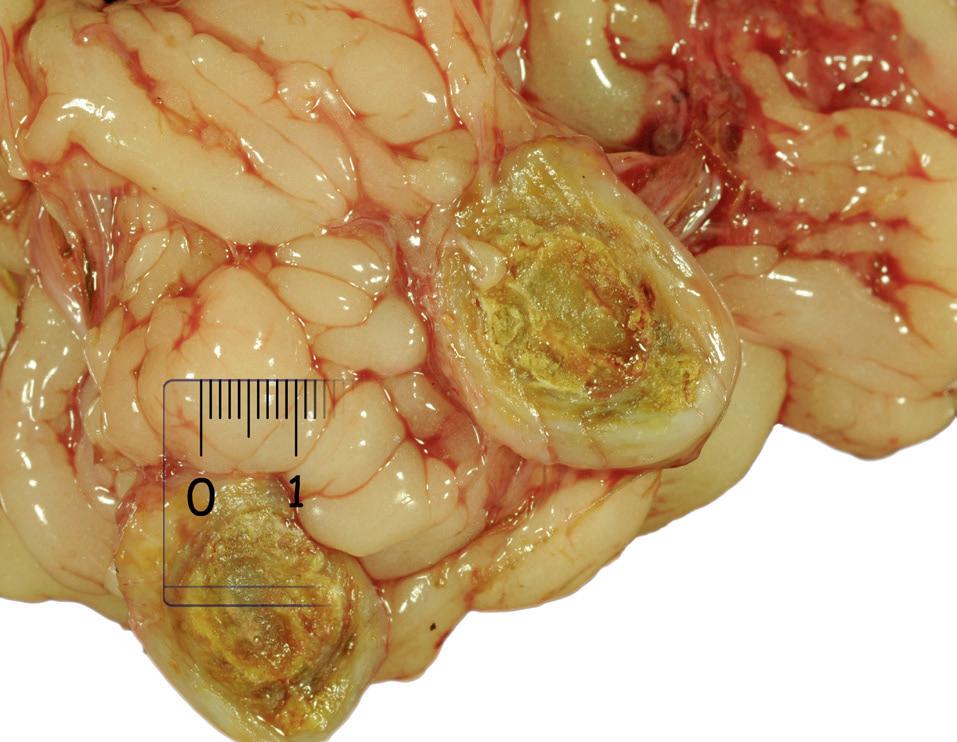 Granulomatöse Entzündung<br>