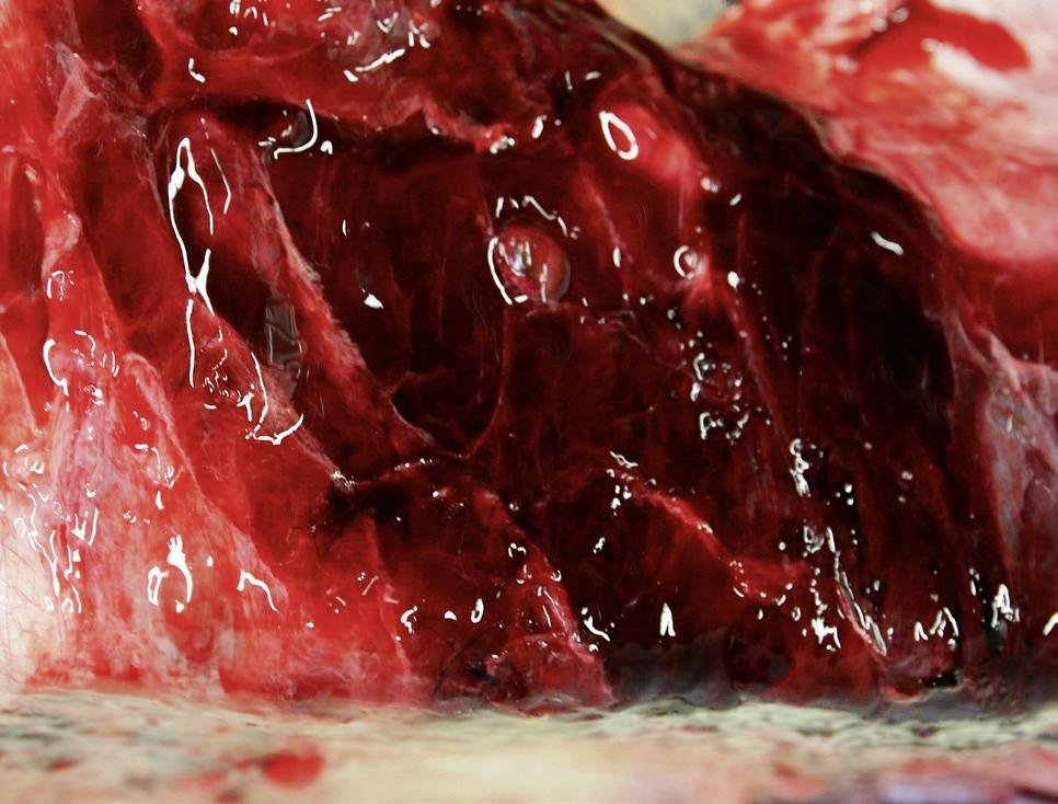 Bluterguss durch traumatische Verletzung<br>