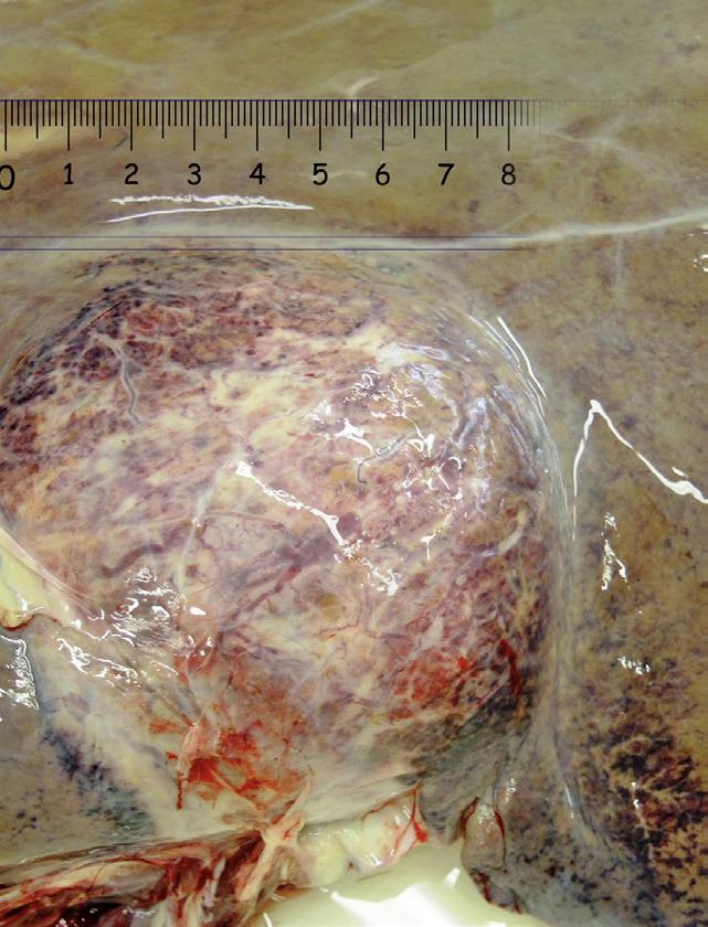 Leber mit Tumor<br>